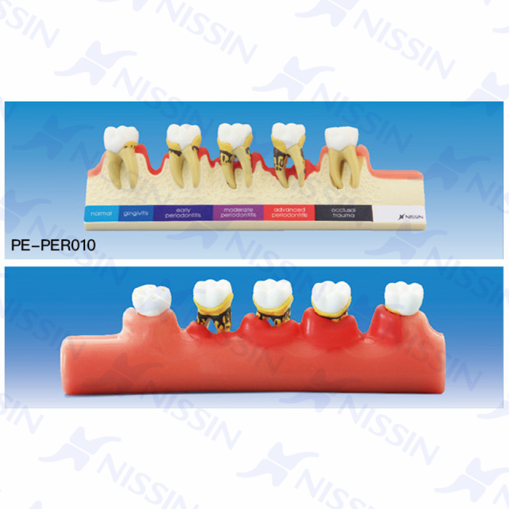牙周病分类模型